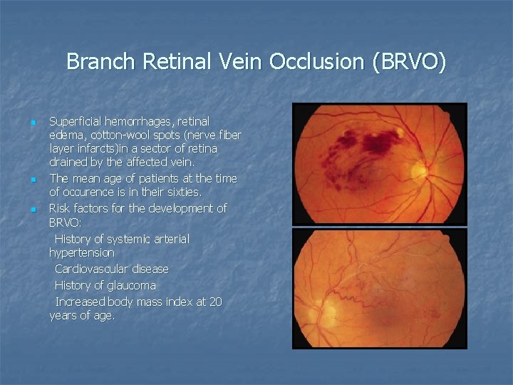 Branch Retinal Vein Occlusion (BRVO) n n n Superficial hemorrhages, retinal edema, cotton-wool spots