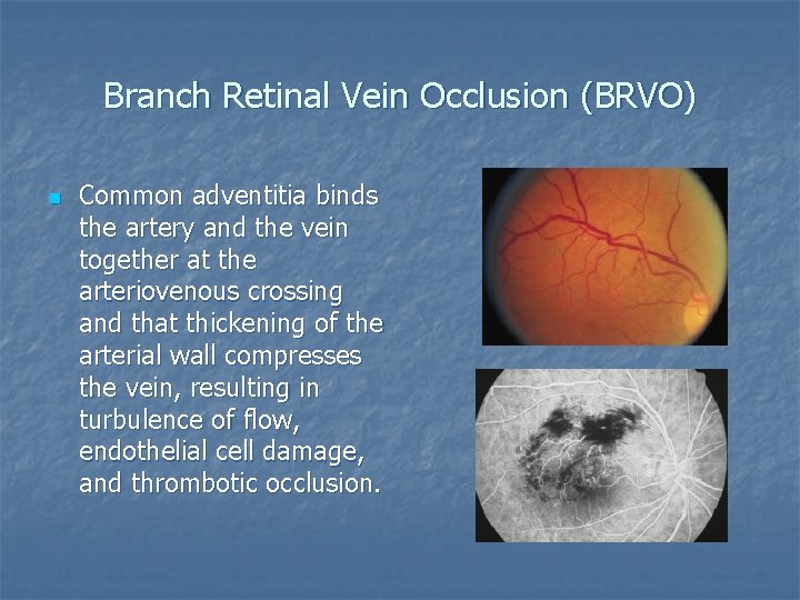 Branch Retinal Vein Occlusion (BRVO) n Common adventitia binds the artery and the vein