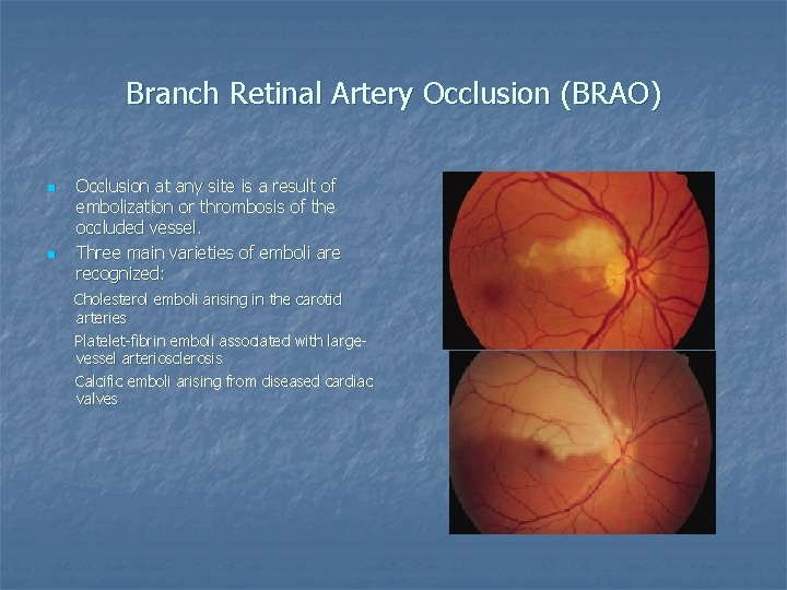 Branch Retinal Artery Occlusion (BRAO) n n Occlusion at any site is a result