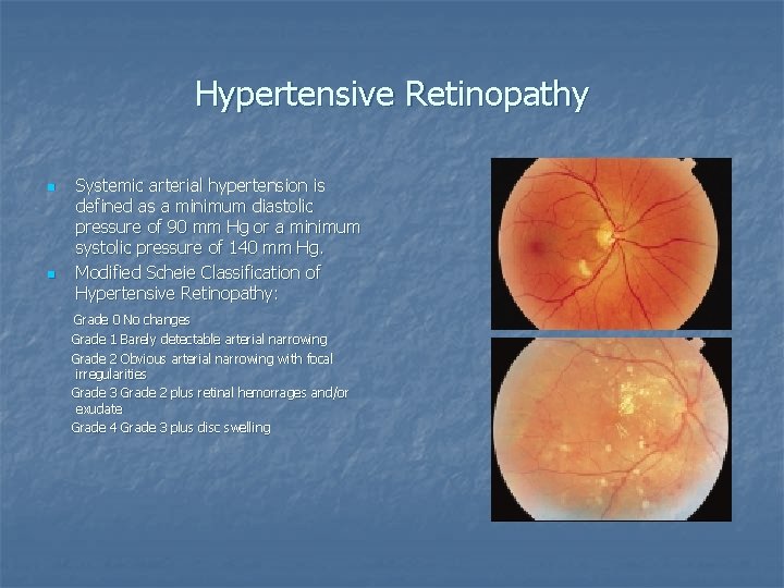 Hypertensive Retinopathy n n Systemic arterial hypertension is defined as a minimum diastolic pressure