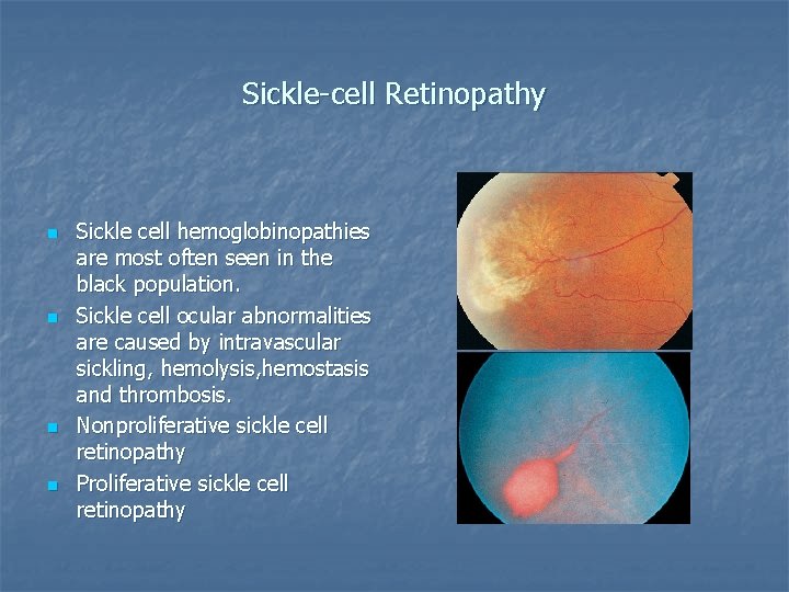 Sickle-cell Retinopathy n n Sickle cell hemoglobinopathies are most often seen in the black