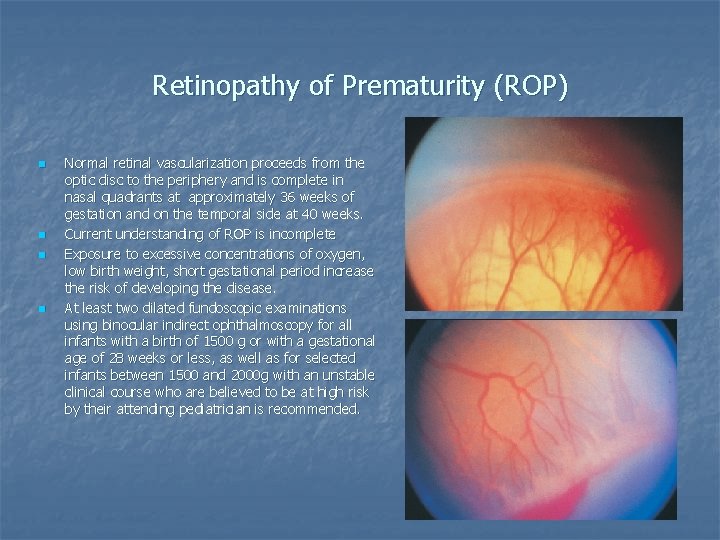 Retinopathy of Prematurity (ROP) n n Normal retinal vascularization proceeds from the optic disc