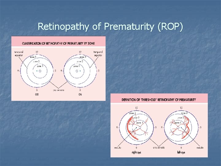 Retinopathy of Prematurity (ROP) 