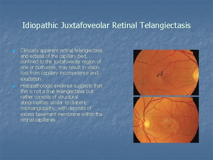 Idiopathic Juxtafoveolar Retinal Telangiectasis n n Clinically apperent retinal telangiectasis and ectasia of the