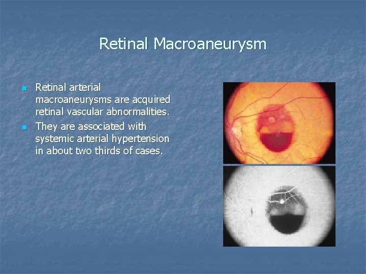 Retinal Macroaneurysm n n Retinal arterial macroaneurysms are acquired retinal vascular abnormalities. They are