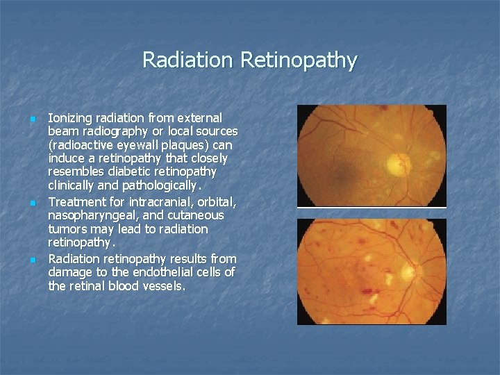 Radiation Retinopathy n n n Ionizing radiation from external beam radiography or local sources