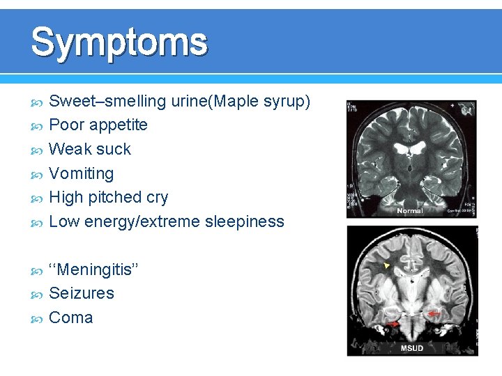 Symptoms Sweet–smelling urine(Maple syrup) Poor appetite Weak suck Vomiting High pitched cry Low energy/extreme