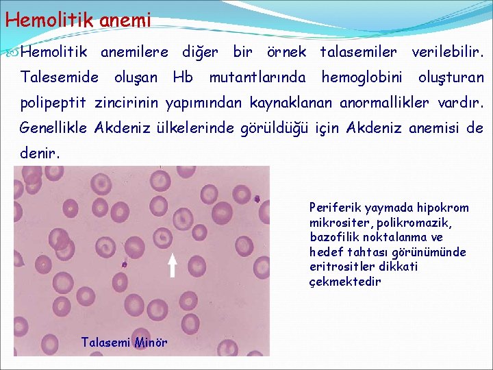 Hemolitik anemilere diğer bir örnek talasemiler verilebilir. Talesemide oluşan Hb mutantlarında hemoglobini oluşturan polipeptit