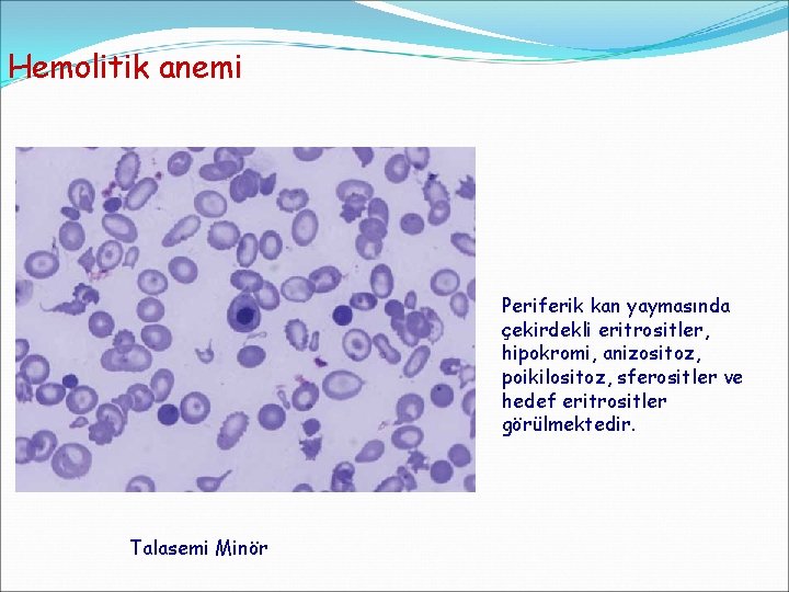 Hemolitik anemi Periferik kan yaymasında çekirdekli eritrositler, hipokromi, anizositoz, poikilositoz, sferositler ve hedef eritrositler