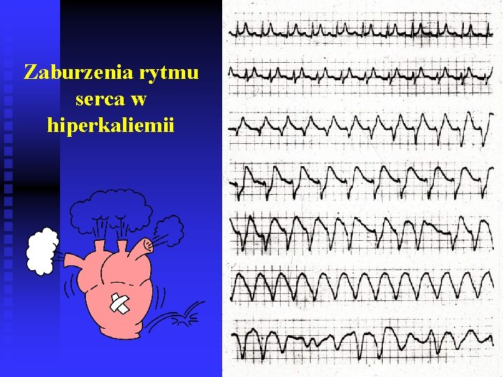 Zaburzenia rytmu serca w hiperkaliemii 