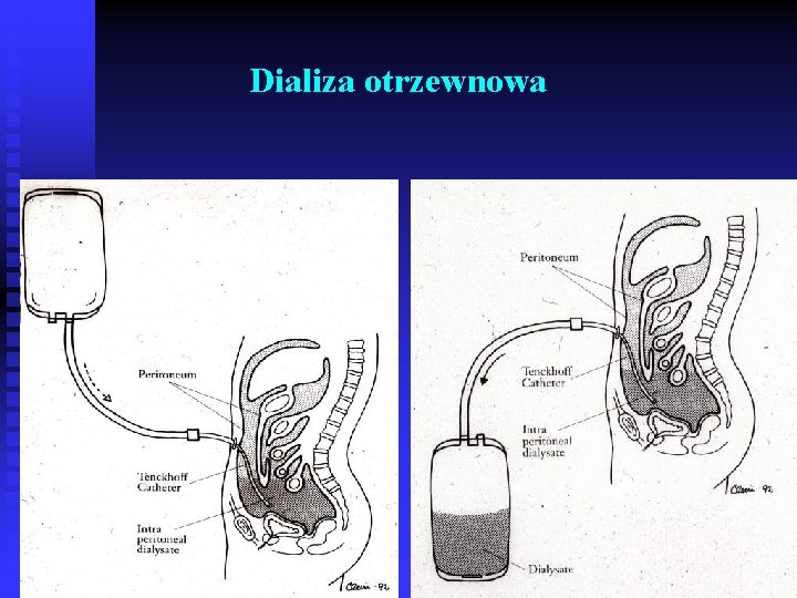 Dializa otrzewnowa 