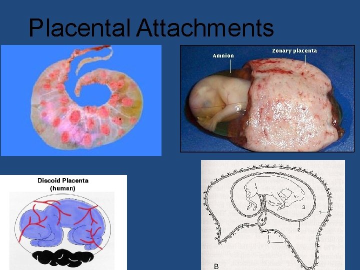 Placental Attachments 