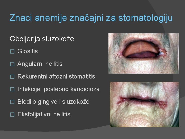 Znaci anemije značajni za stomatologiju Oboljenja sluzokože � Glositis � Angularni heilitis � Rekurentni