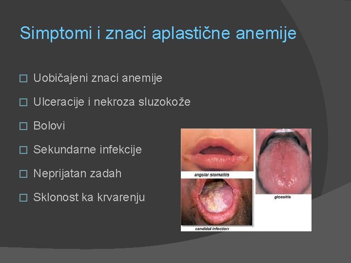 Simptomi i znaci aplastične anemije � Uobičajeni znaci anemije � Ulceracije i nekroza sluzokože