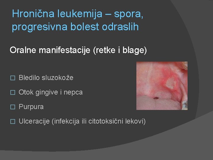 Hronična leukemija – spora, progresivna bolest odraslih Oralne manifestacije (retke i blage) � Bledilo