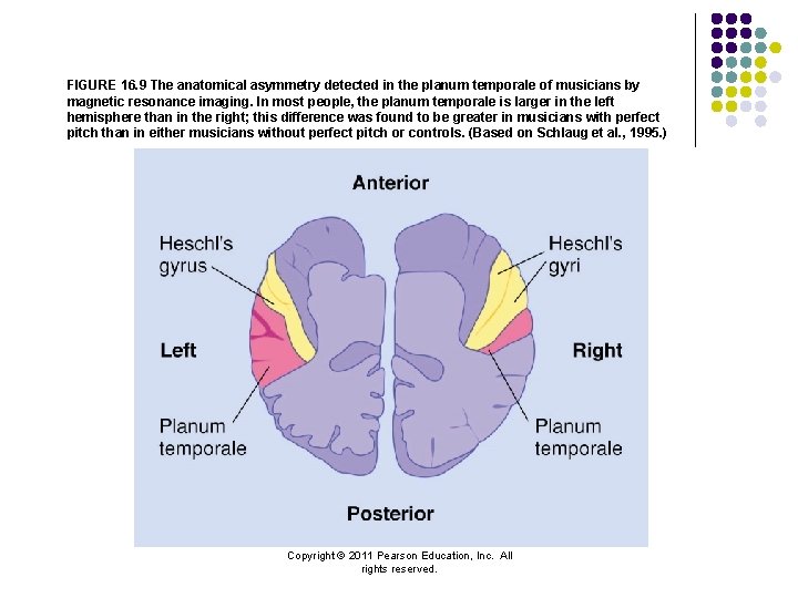 FIGURE 16. 9 The anatomical asymmetry detected in the planum temporale of musicians by