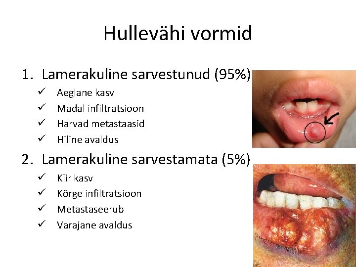 Hullevähi vormid 1. Lamerakuline sarvestunud (95%) ü ü Aeglane kasv Madal infiltratsioon Harvad metastaasid