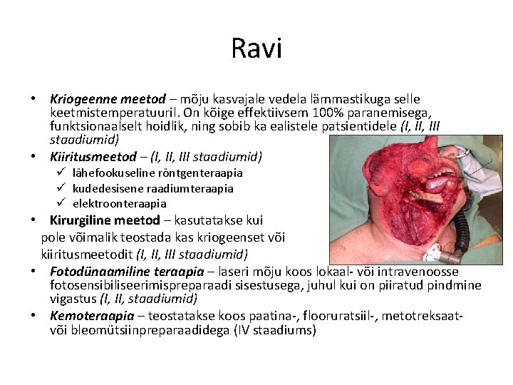 Ravi • Kriogeenne meetod – mõju kasvajale vedela lämmastikuga selle keetmistemperatuuril. On kõige effektiivsem