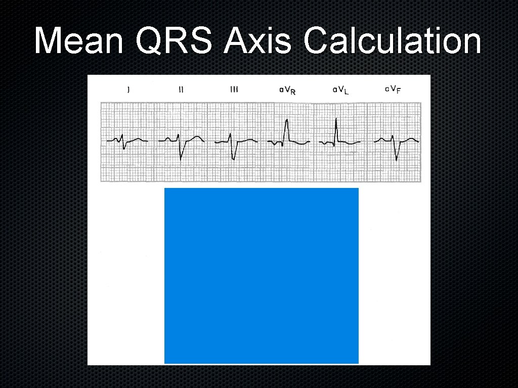 Mean QRS Axis Calculation 