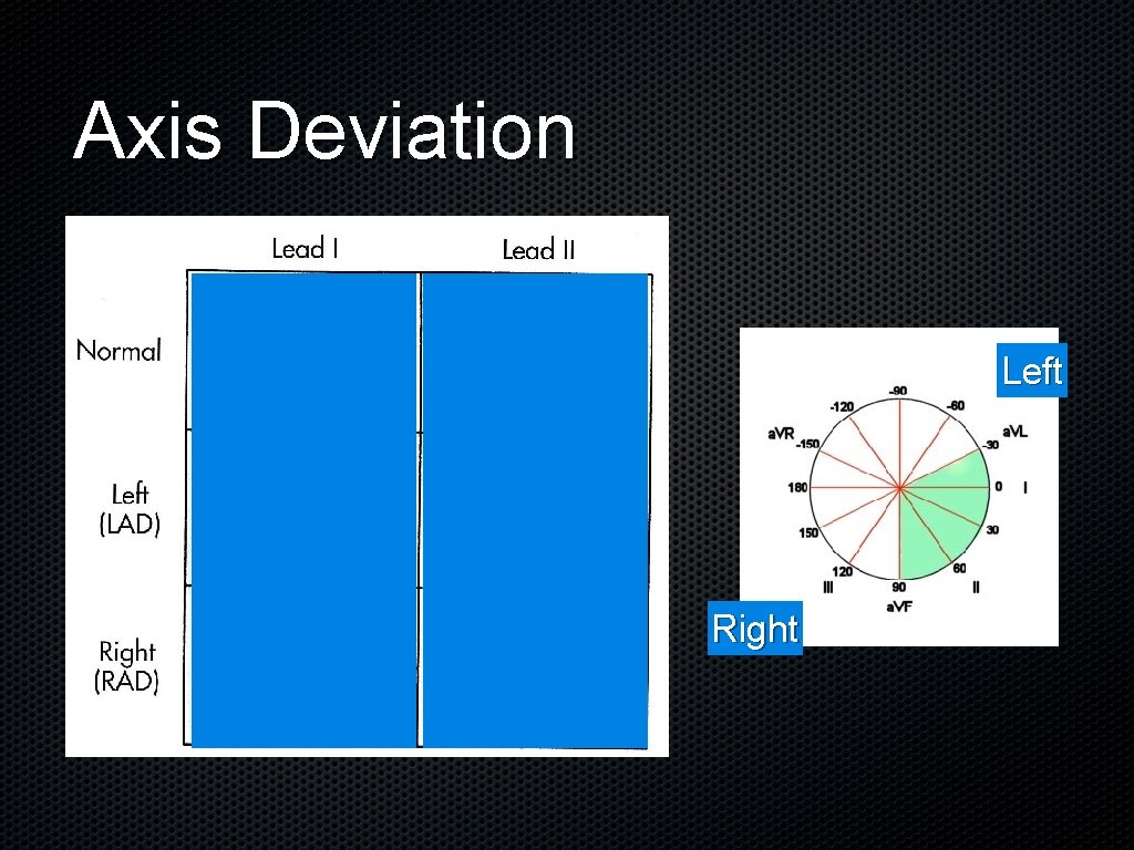 Axis Deviation Left Right 