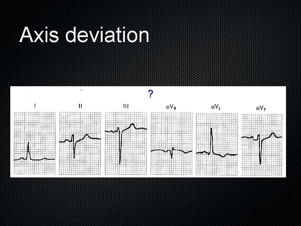 Axis deviation ? 
