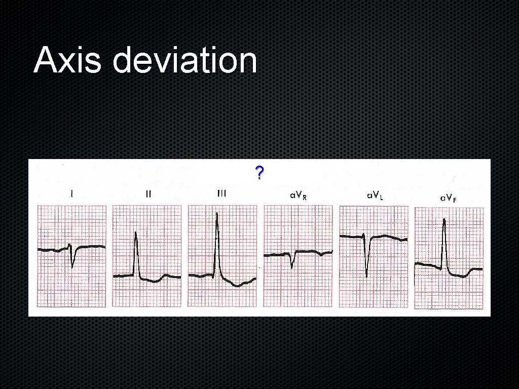 Axis deviation ? 