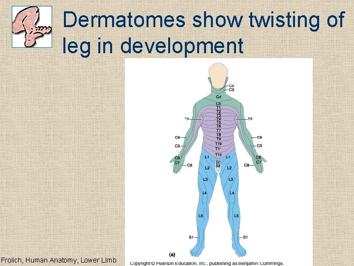 Dermatomes show twisting of leg in development Frolich, Human Anatomy, Lower LImb 