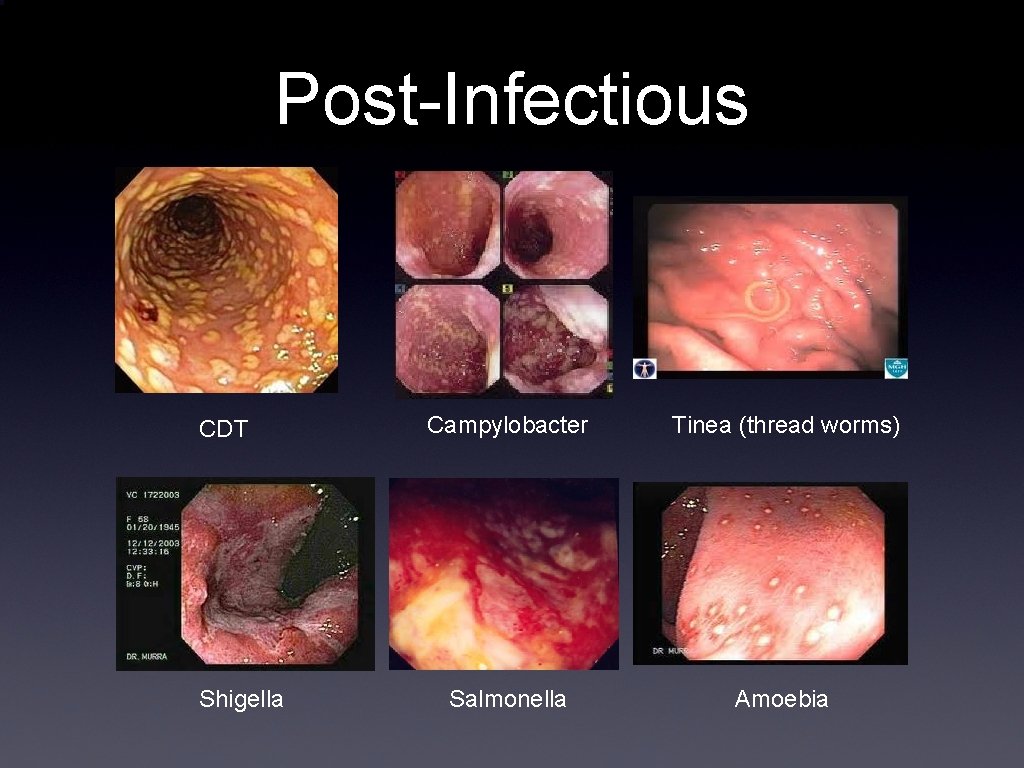 Post-Infectious CDT Shigella Campylobacter Tinea (thread worms) Salmonella Amoebia 