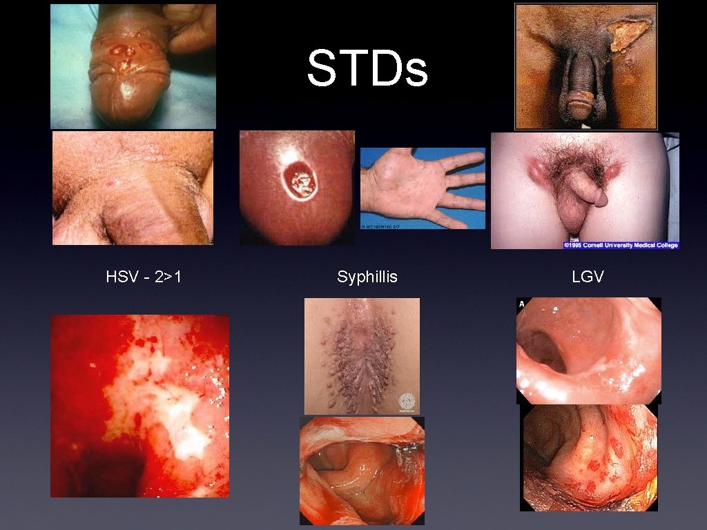STDs HSV - 2>1 Syphillis LGV 