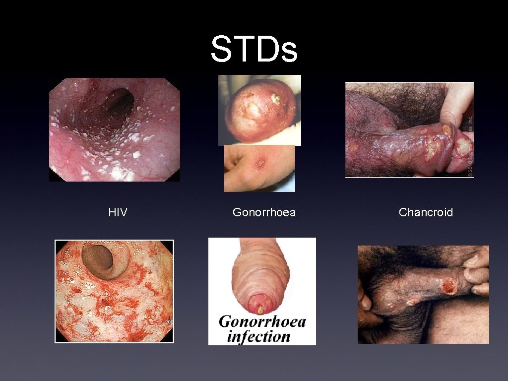 STDs HIV Gonorrhoea Chancroid 