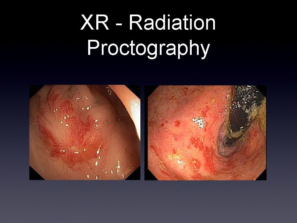XR - Radiation Proctography 
