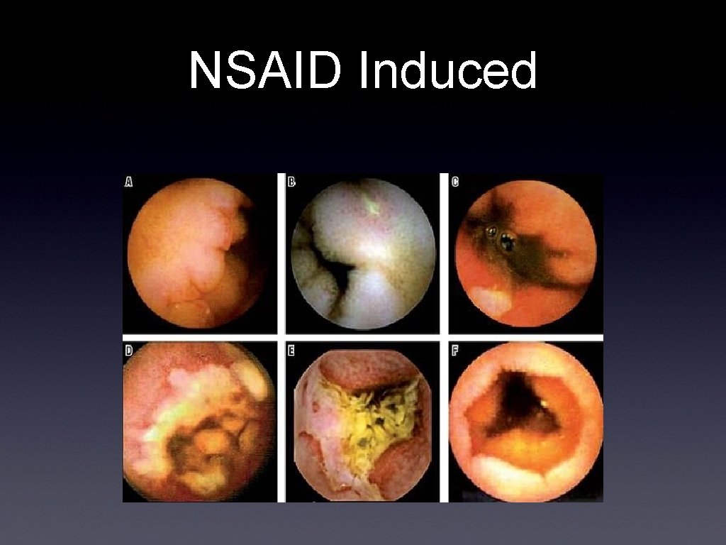 NSAID Induced 