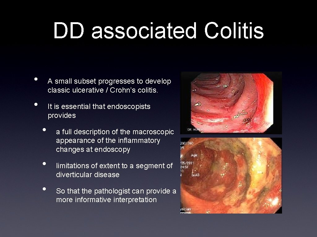DD associated Colitis • A small subset progresses to develop classic ulcerative / Crohn’s