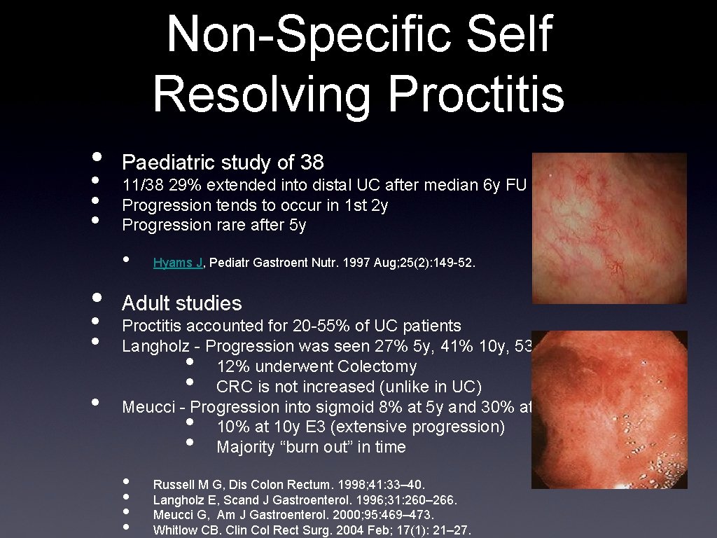 Non-Specific Self Resolving Proctitis • • Paediatric study of 38 11/38 29% extended into