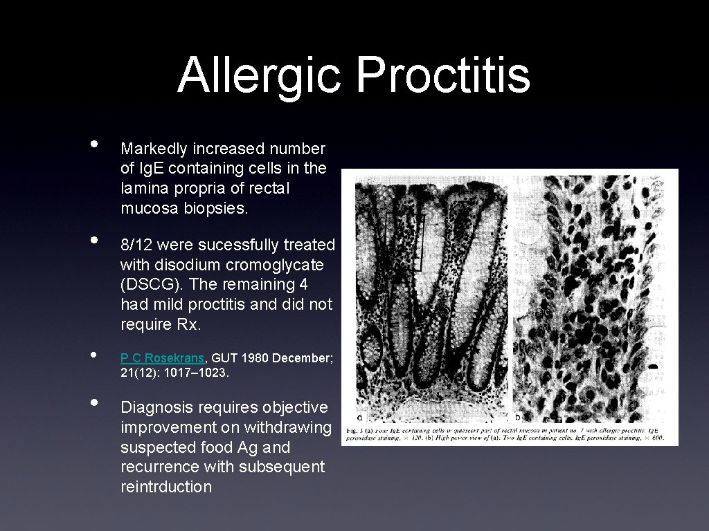 Allergic Proctitis • • Markedly increased number of Ig. E containing cells in the