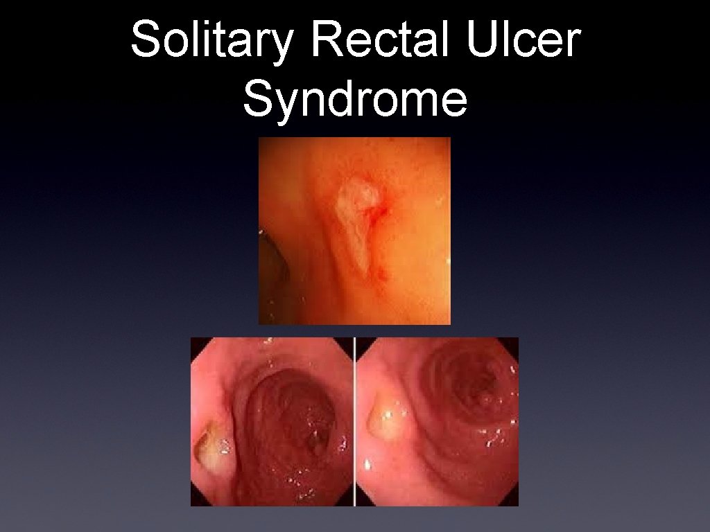Solitary Rectal Ulcer Syndrome 
