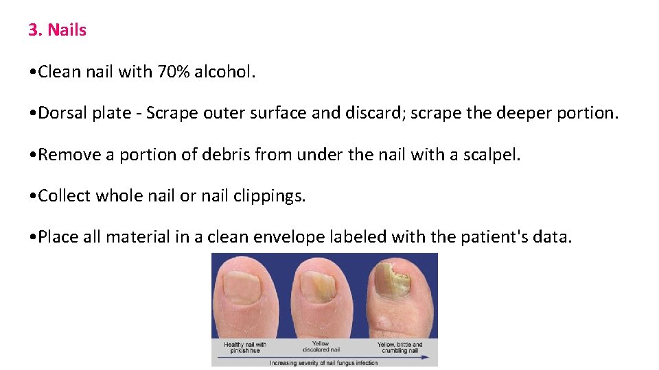 3. Nails • Clean nail with 70% alcohol. • Dorsal plate - Scrape outer