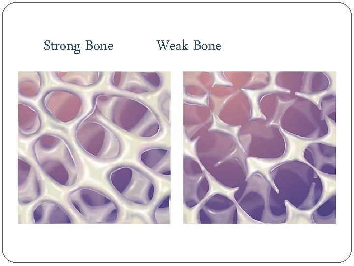 Strong Bone Weak Bone 