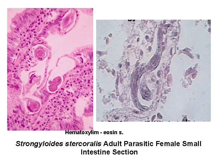 Hematoxylim - eosin s. Strongyloides stercoralis Adult Parasitic Female Small Intestine Section 