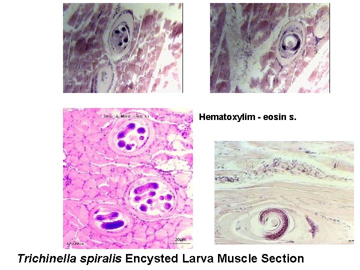 Hematoxylim - eosin s. Trichinella spiralis Encysted Larva Muscle Section 