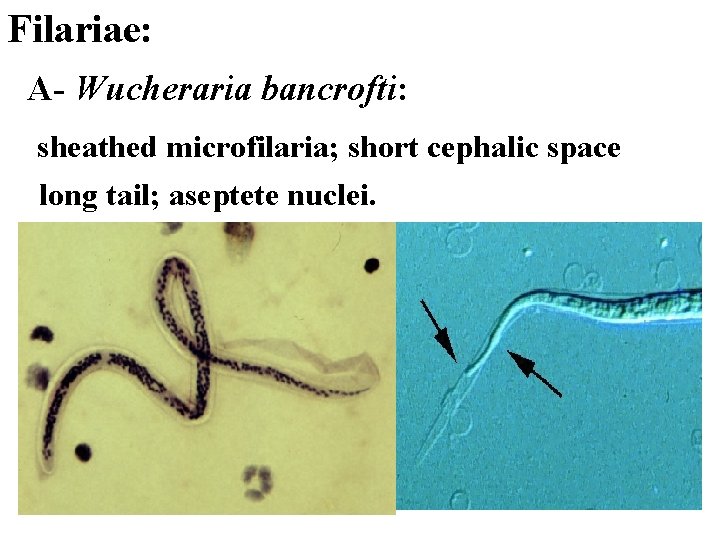 Filariae: A- Wucheraria bancrofti: sheathed microfilaria; short cephalic space long tail; aseptete nuclei. 