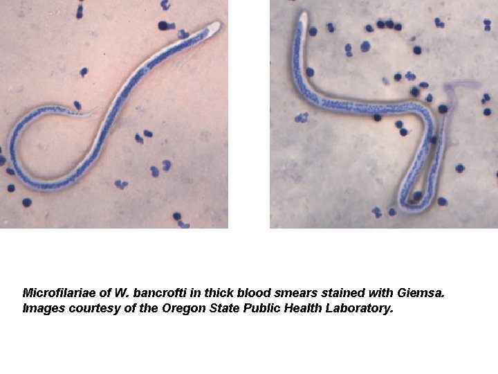 Microfilariae of W. bancrofti in thick blood smears stained with Giemsa. Images courtesy of