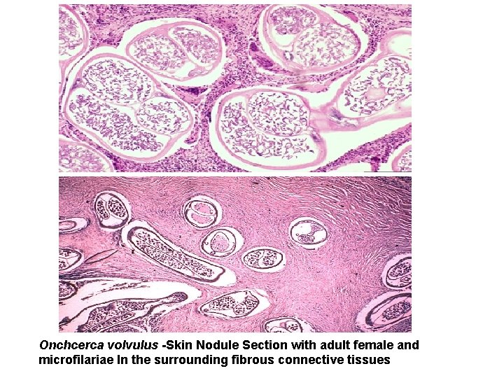 Onchcerca volvulus -Skin Nodule Section with adult female and microfilariae In the surrounding fibrous