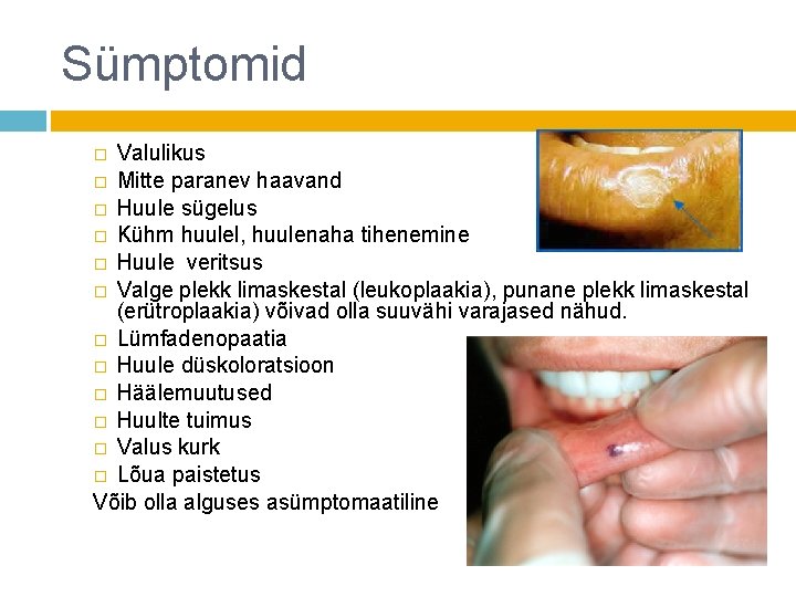 Sümptomid Valulikus � Mitte paranev haavand � Huule sügelus � Kühm huulel, huulenaha tihenemine