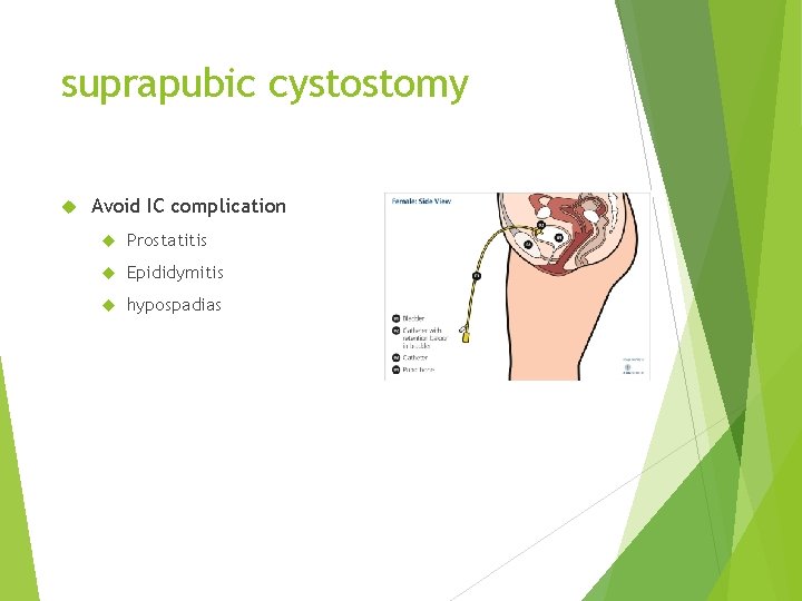 suprapubic cystostomy Avoid IC complication Prostatitis Epididymitis hypospadias 