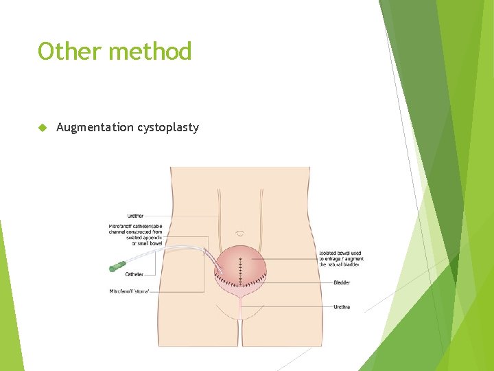 Other method Augmentation cystoplasty 