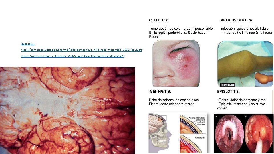 Izvor slike : https: //commons. wikimedia. org/wiki/File: Haemophilus_influenzae_meningitis_5003_lores. jpg https: //www. slideshare. net/oskarp_9206/diapositivas-haemophilus-influenzae/3 