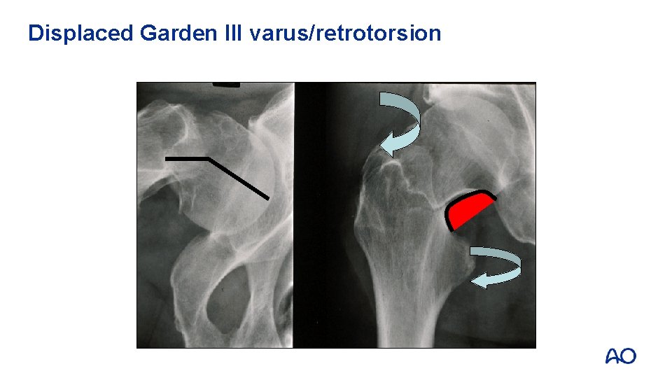 Displaced Garden III varus/retrotorsion 