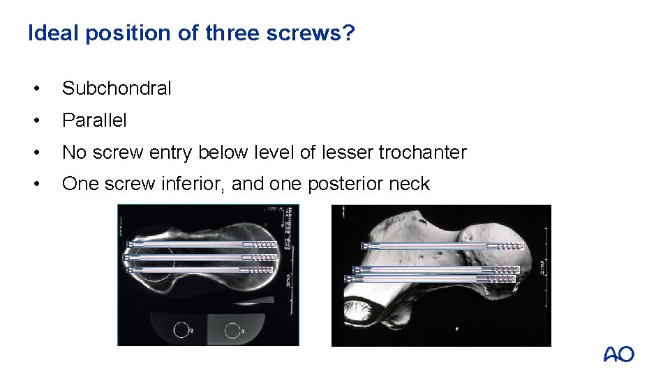 Ideal position of three screws? • Subchondral • Parallel • No screw entry below