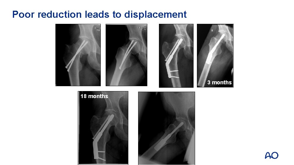 Poor reduction leads to displacement 3 months 18 months 